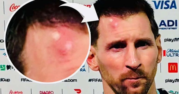 Messi sưng trán sau trận thắng Cabo Verde: Chấn thương nhỏ, niềm vui lớn và cơ hội cho fan cá cược - hình ảnh - x88beta.com Messi sưng trán sau trận thắng Cabo Verde: Chấn thương nhỏ, niềm vui lớn và cơ hội cho fan cá cược - hình ảnh - x88beta.com